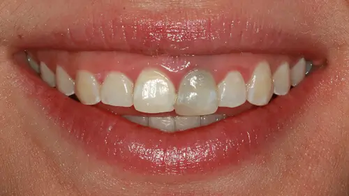 Clear Aligner Therapie 8