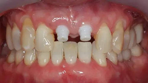 Keramikimplantate 37