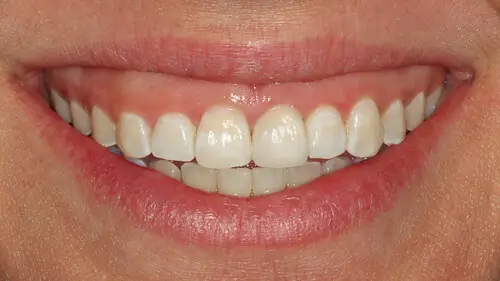 Clear Aligner Therapie 10