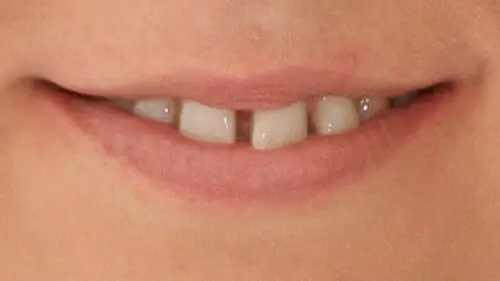 Clear Aligner Therapie 11