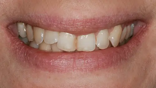 Clear Aligner Therapie 13