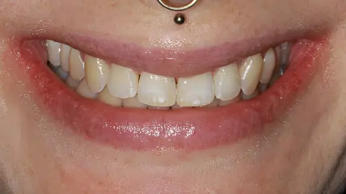 Clear Aligner Therapie 14