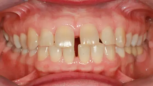 Clear Aligner Therapie 15