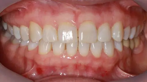 Clear Aligner Therapie 16