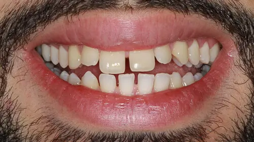 Clear Aligner Therapie 17