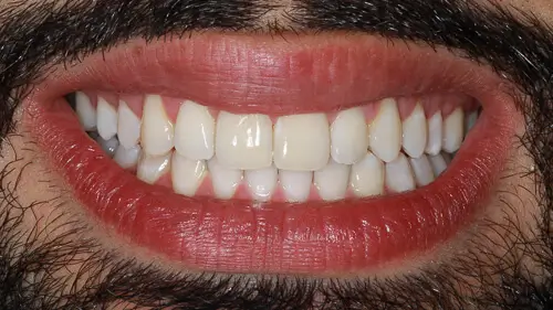Clear Aligner Therapie 18