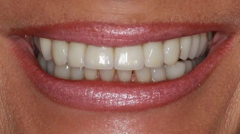 Clear Aligner Therapie 2