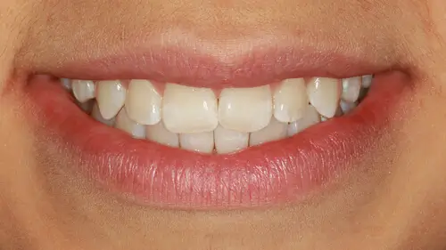 Clear Aligner Therapie 22