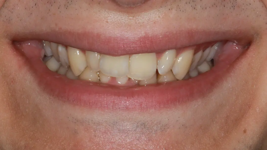 Clear Aligner Therapie 23