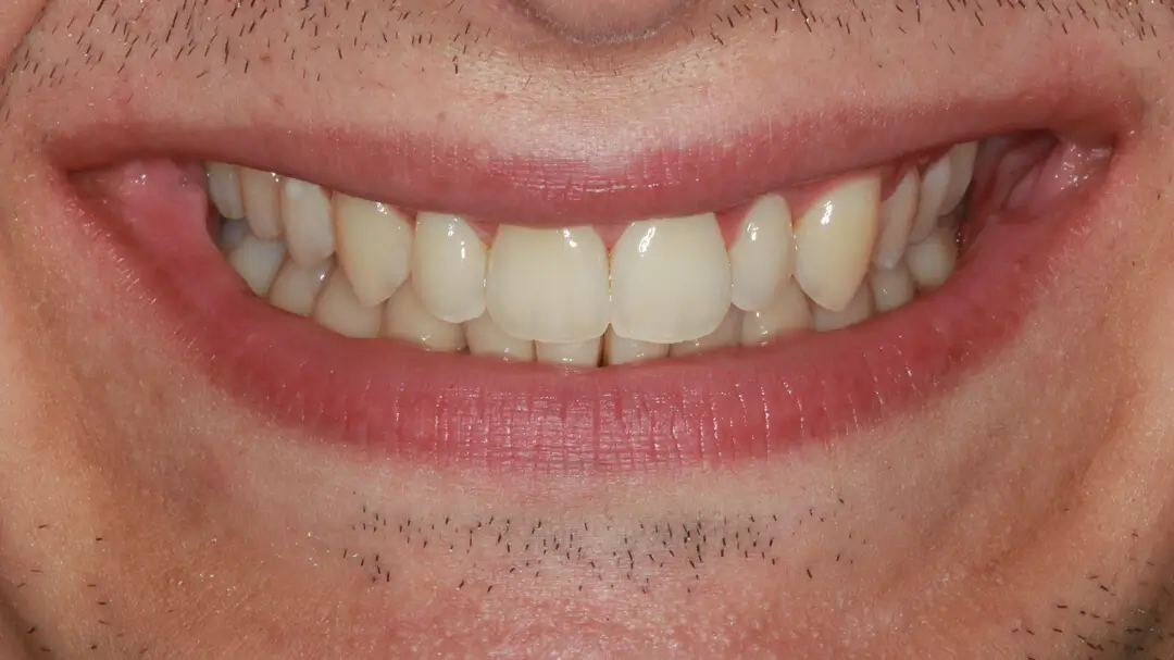 Clear Aligner Therapie 24