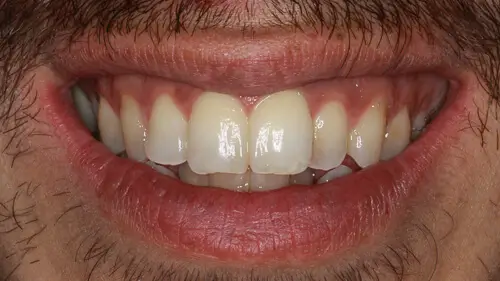 Clear Aligner Therapie 25