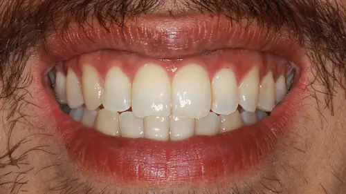 Clear Aligner Therapie 26