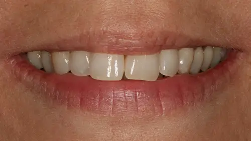 Clear Aligner Therapie 27