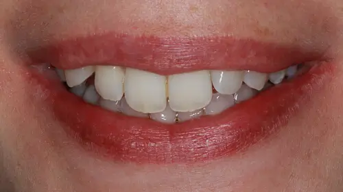 Clear Aligner Therapie 29