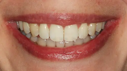 Clear Aligner Therapie 30
