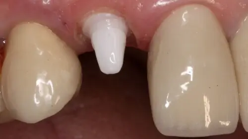 Keramikimplantate 31