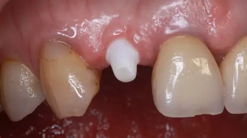 Keramikimplantate 33