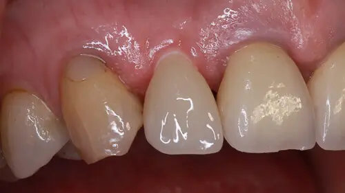 Keramikimplantate 34