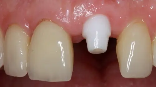Keramikimplantate 35