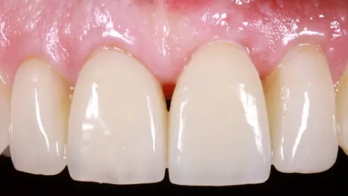 Keramikimplantate 36