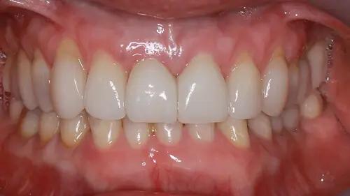 Keramikimplantate 38
