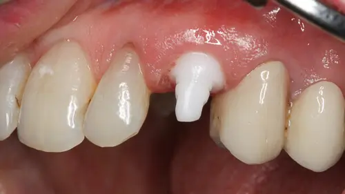 Keramikimplantate 39