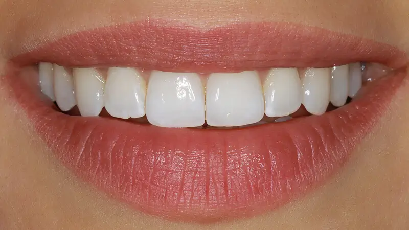 Clear Aligner Therapie 4
