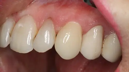 Keramikimplantate 40