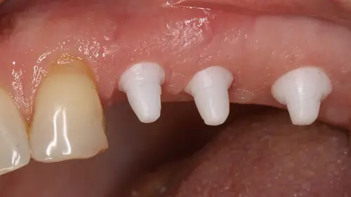 Keramikimplantate 43