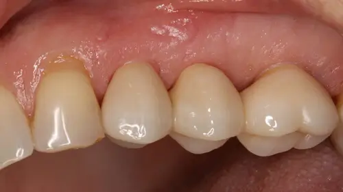 Keramikimplantate 44