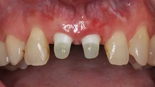 Keramikimplantate 47