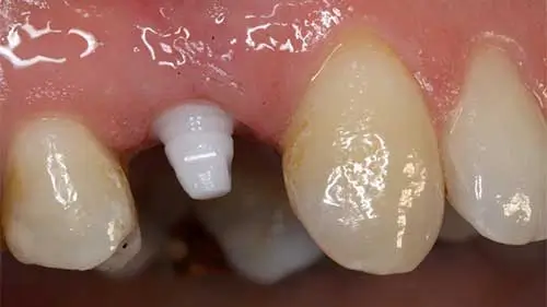 Keramikimplantate 49