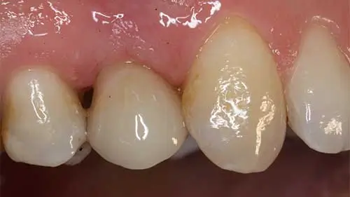 Keramikimplantate 50