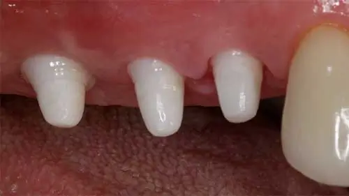 Keramikimplantate 51