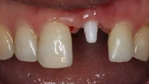 Keramikimplantate 55