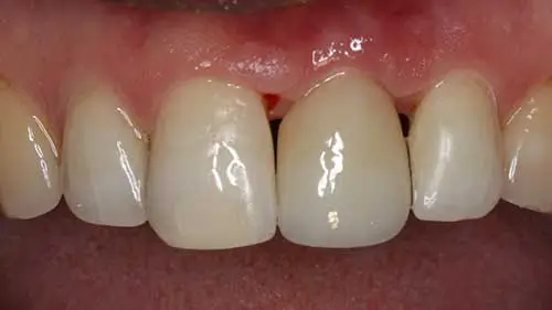 Keramikimplantate 56