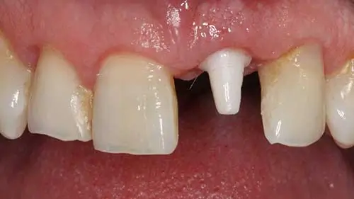 Keramikimplantate 57