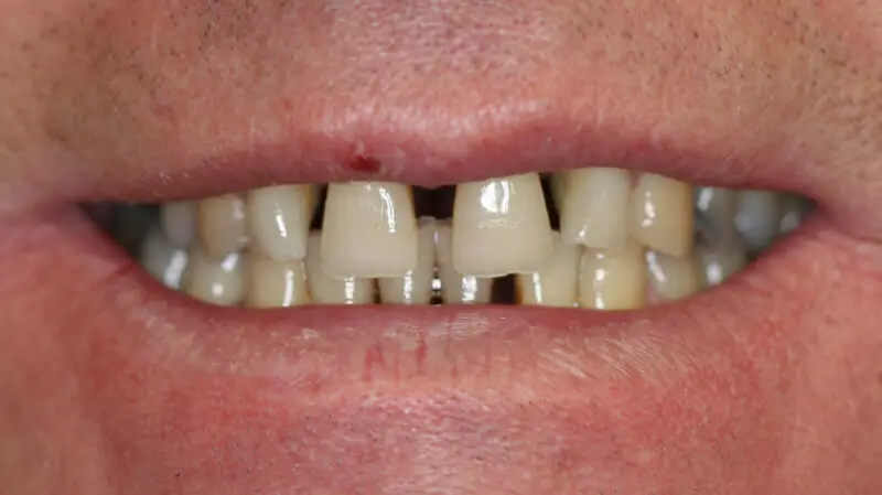 Kronen und Veneers 61
