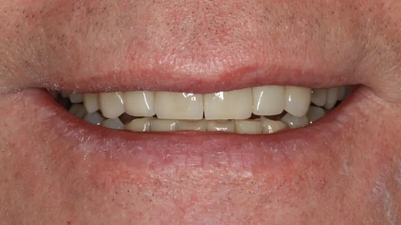 Kronen und Veneers 62