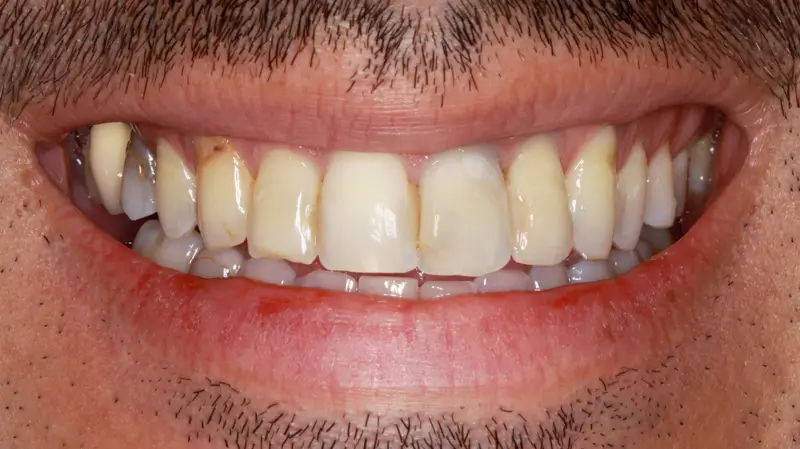 Kronen und Veneers 63