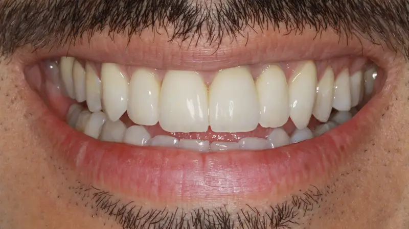 Kronen und Veneers 64