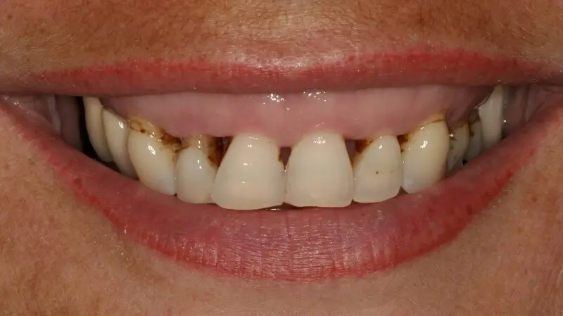 Kronen und Veneers 65