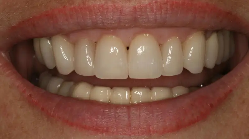Kronen und Veneers 66