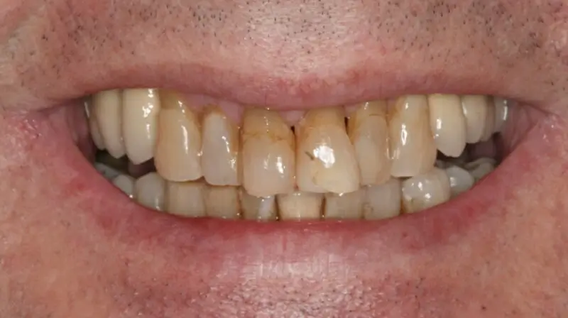 Kronen und Veneers 67