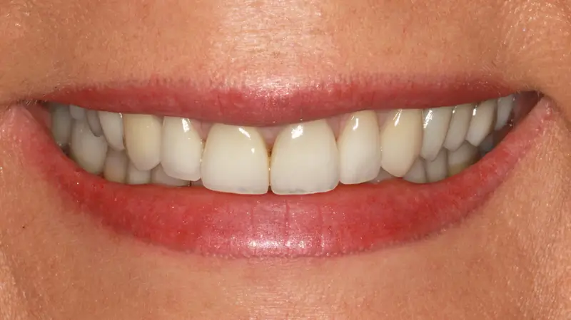 Kronen und Veneers 70
