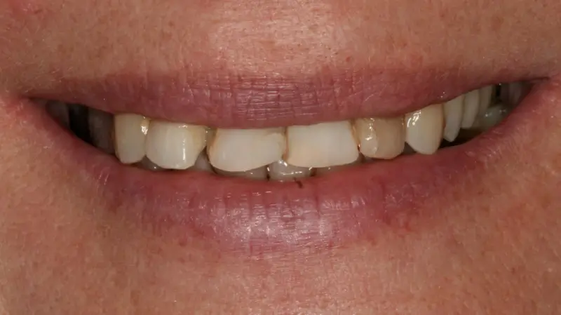 Kronen und Veneers 71
