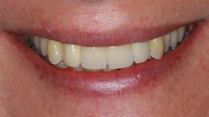 Kronen und Veneers 72