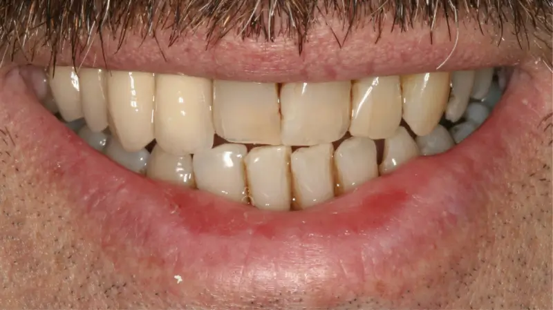 Kronen und Veneers 75