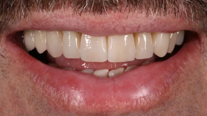 Kronen und Veneers 76