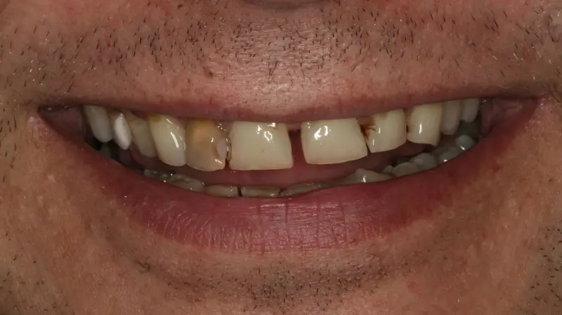 Kronen und Veneers 77